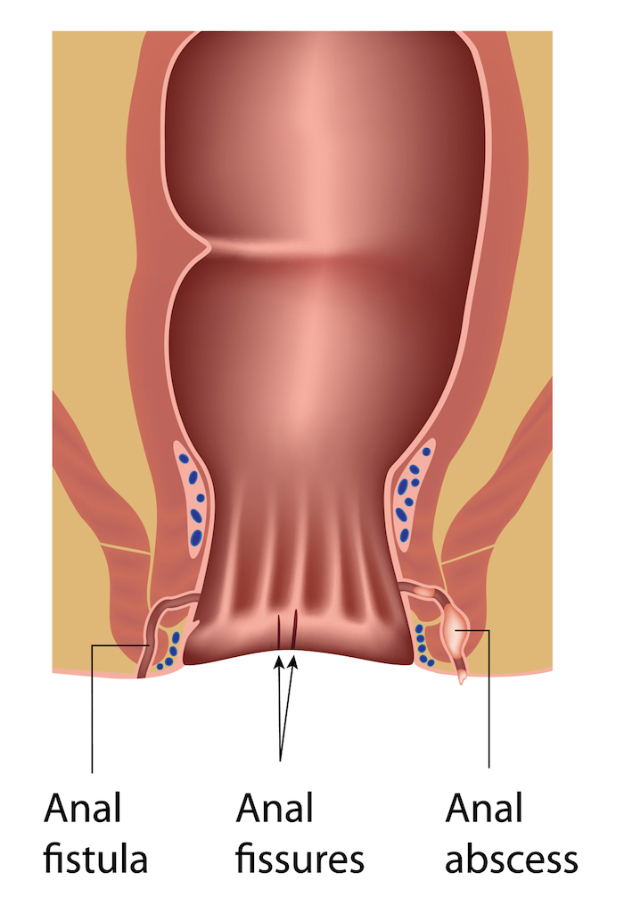 anal fistula treatments