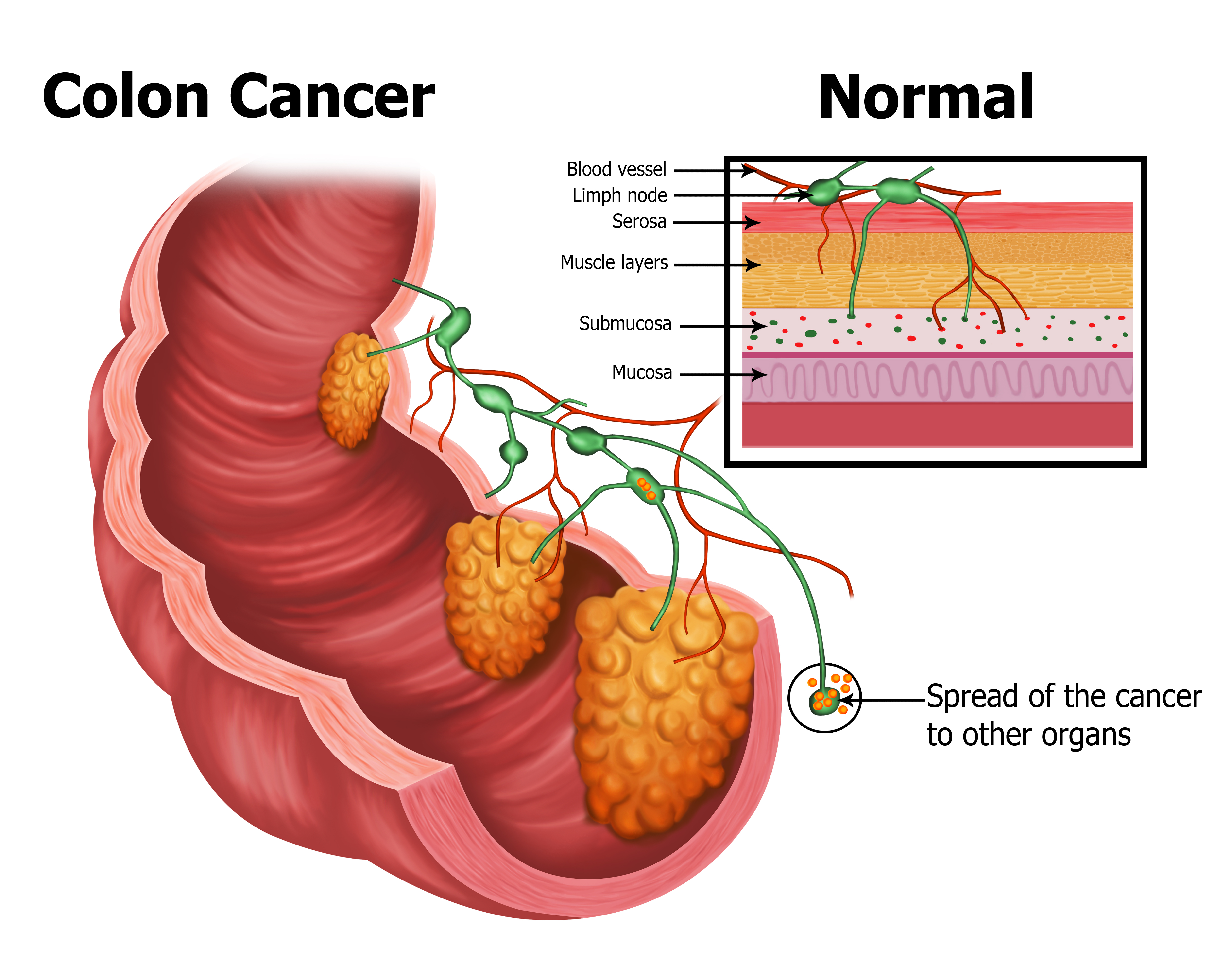 Colon Cancer